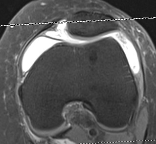 Medial Parapatella Plica MRI